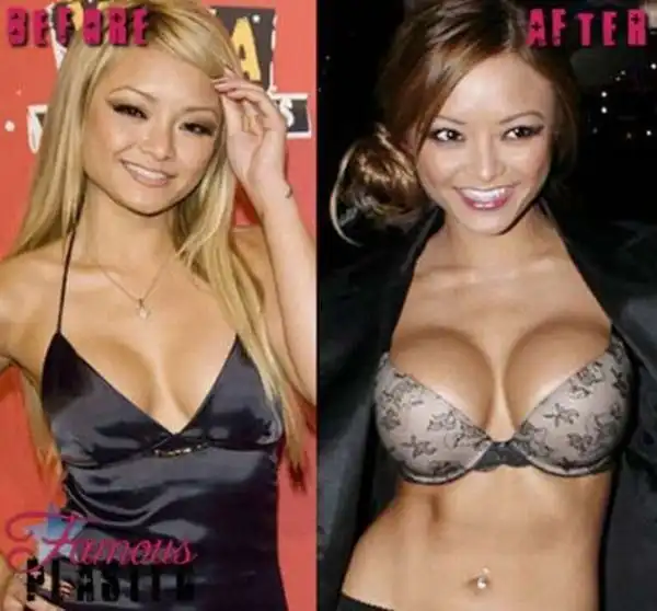 Звезды с увеличенной грудью