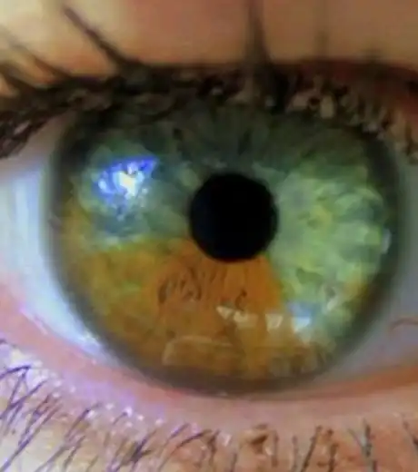 Медики научились менять цвет глаз с помощью лазера