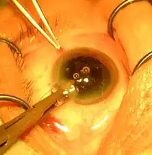 Как проводят операции на глаза?