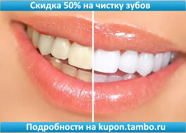 Профессиональная чистка зубов со скидкой 50% от «Стоматолог и Я»