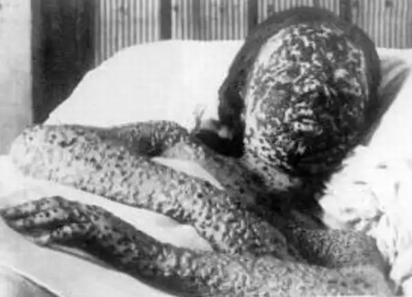 ТОП-5 самых необычных эпидемий в истории