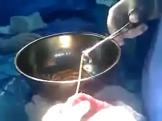 Хирургическое удаление червей из кишечника....