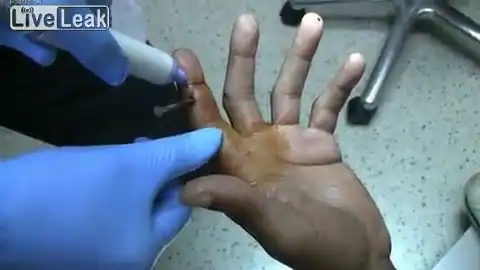 Удаление гвоздя из пальца