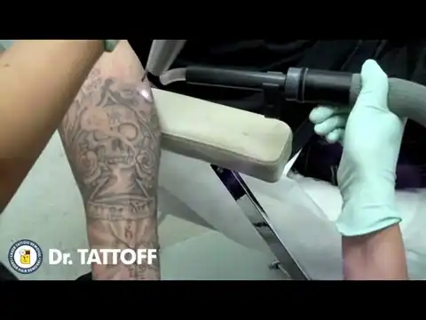 Как с помощью лазера выводят татуировки