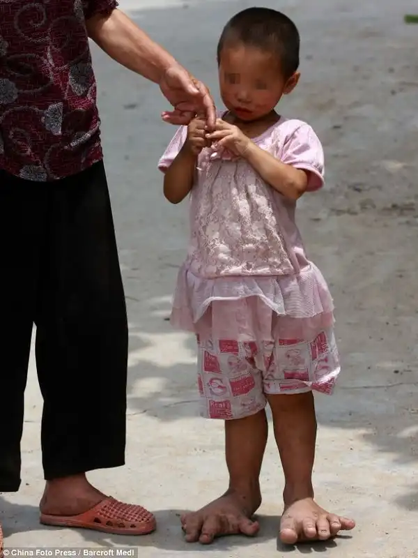 3-х летняя китаянка не может носить обувь