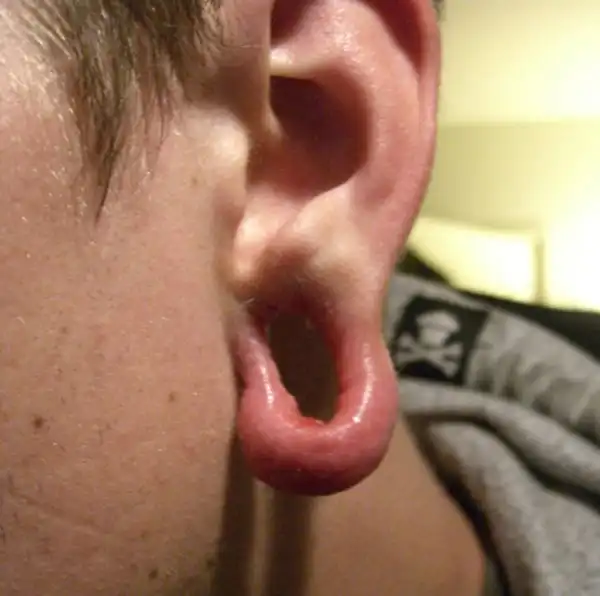 Последствия каналов в ушах