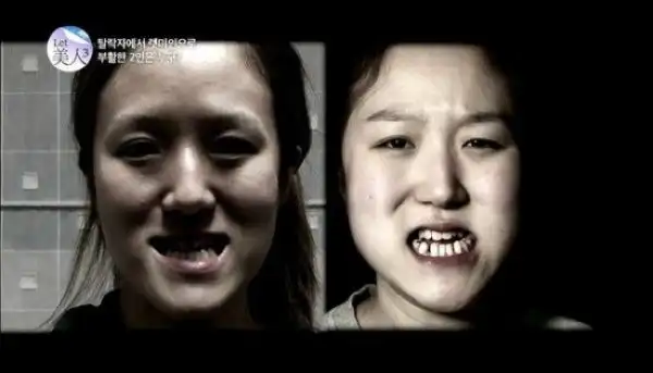 Корейские близняшки до и после пластической операции