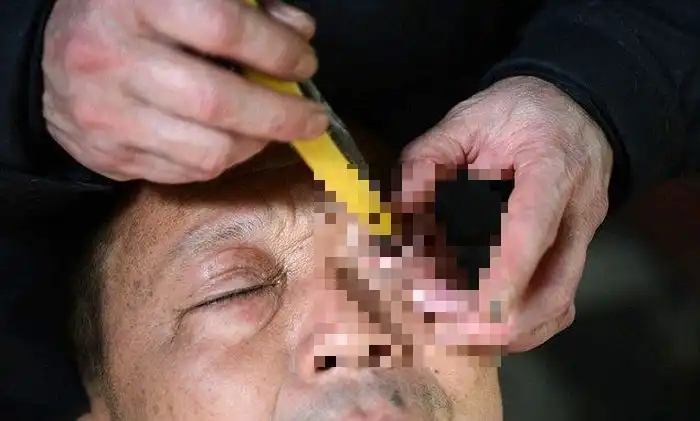 Китайская процедура "бритья" глаз