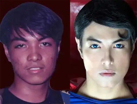 Хирурги 16 лет вырезали из филиппинца Супермена