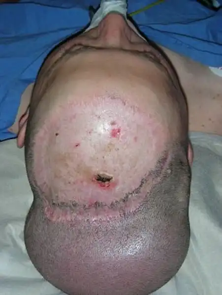 Как мужику надули голову, чтобы избавить от лысины