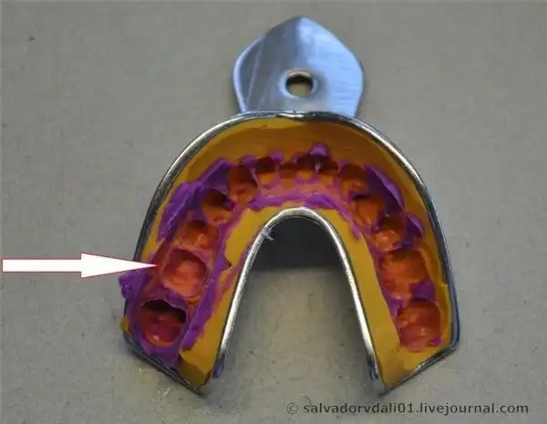 Как делают зубные коронки