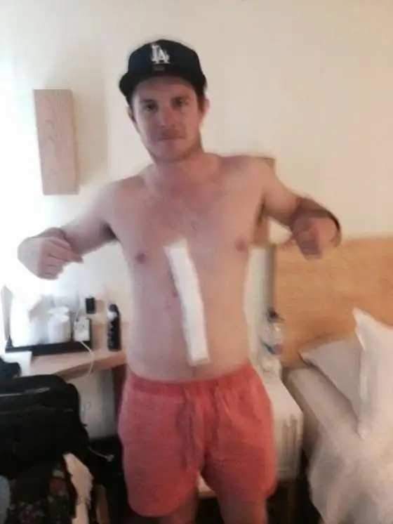 Клещ прожил под кожей парня три дня