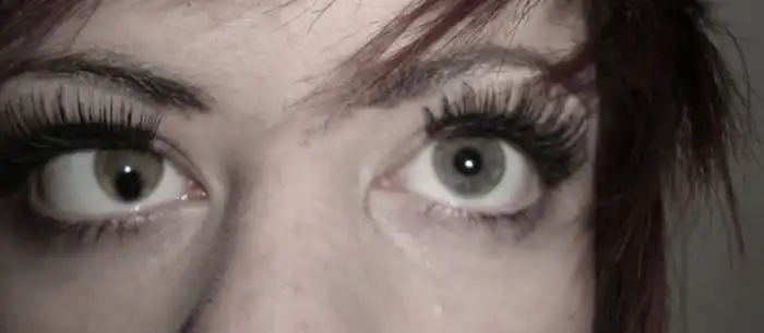 Заболевание колобома и его последствия