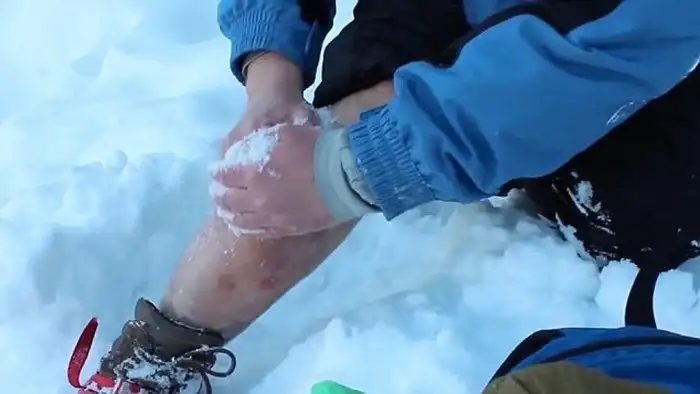 Русский альпинист сам прооперировал себе ногу, используя снег в качестве анестезии