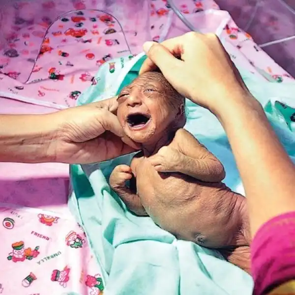 Двухнедельный младенец с редким заболеванием кожи