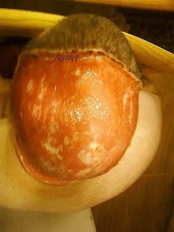 Как убирают "целлюлит" на черепе