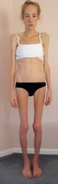 Больная анорексией девушка набрала 40 кг за 7 месяцев