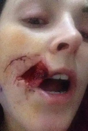 Пьяный мужик откусил девушке кусок щеки