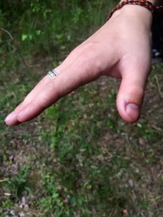 Как наш организм переносит укус гадюки