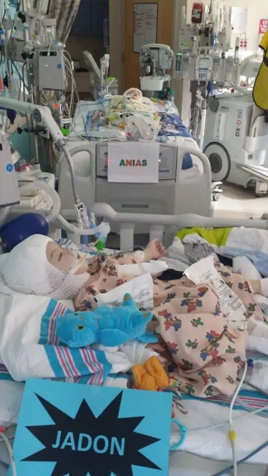 Разделенные сиамские близнецы впервые посмотрели друг на друга