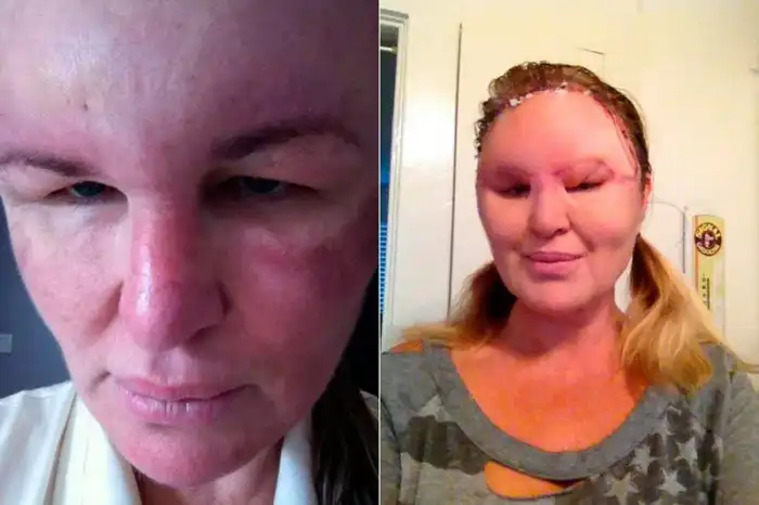 После инъекции ботокса женщина превратилась в "одноглазого монстра"