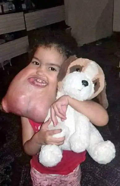 Врачи удалили с лица трехлетней девочки опухоль массой болье двух килограмм