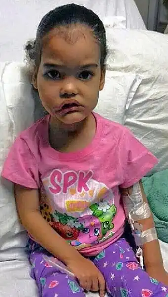 Врачи удалили с лица трехлетней девочки опухоль массой болье двух килограмм