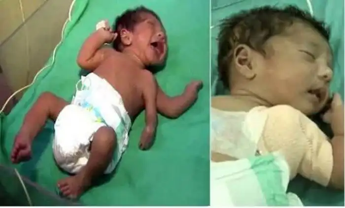 Дети, рожденные с невероятными генетическими дефектами