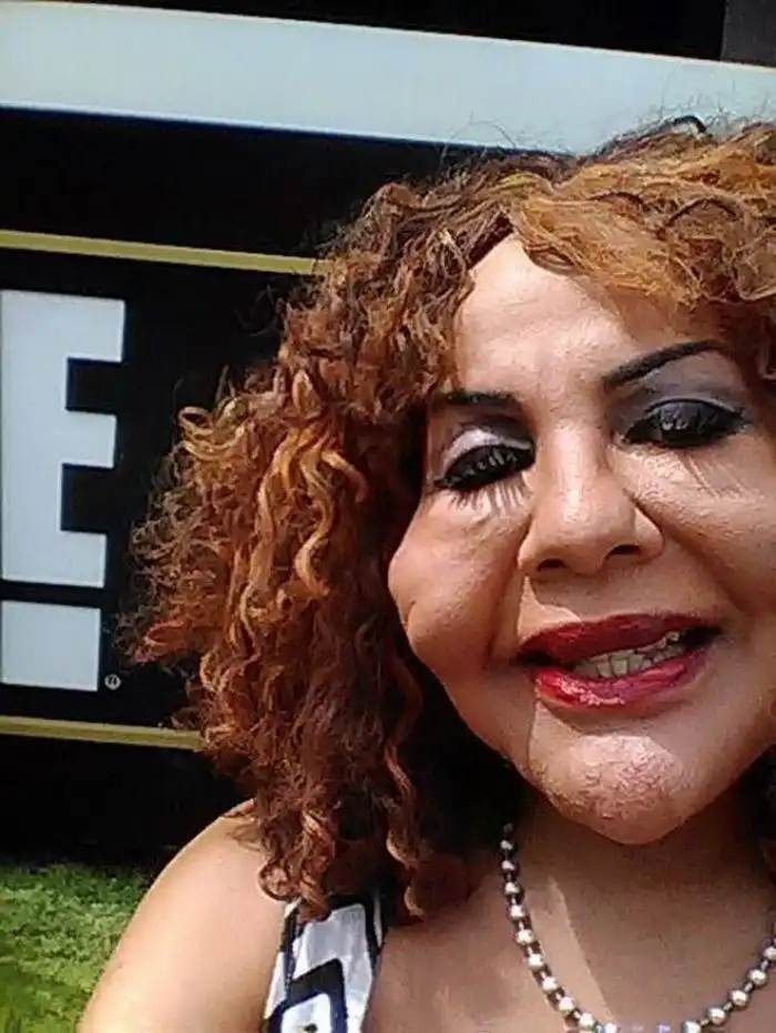 Пластический хирург-шарлатан ввел ей под кожу цемент