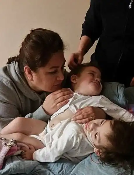 Хирургам удалось разделить сиамских близняшек с общим пищеварительным трактом и парой ног