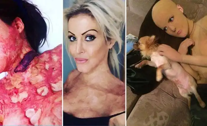 Её подожгла ревнивая жена и 200 операций лишь немного сгладили ужас произошедшего