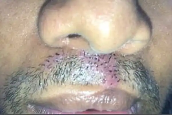 Индийцу пересадили волосы с головы на лицо, чтобы скрыть следы заячьей губы