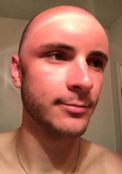 Последствия неудачного загара