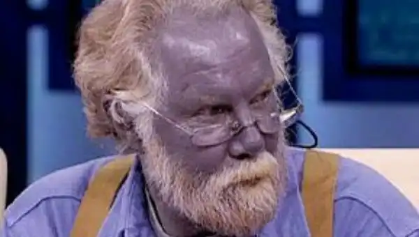 12 странных болезней и синдромов, при виде которых медики лишь разводят руками