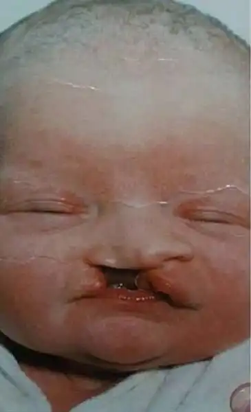 После 10 операций девушка с волчьей пастью настолько преобразилась, что ее перестали узнавать