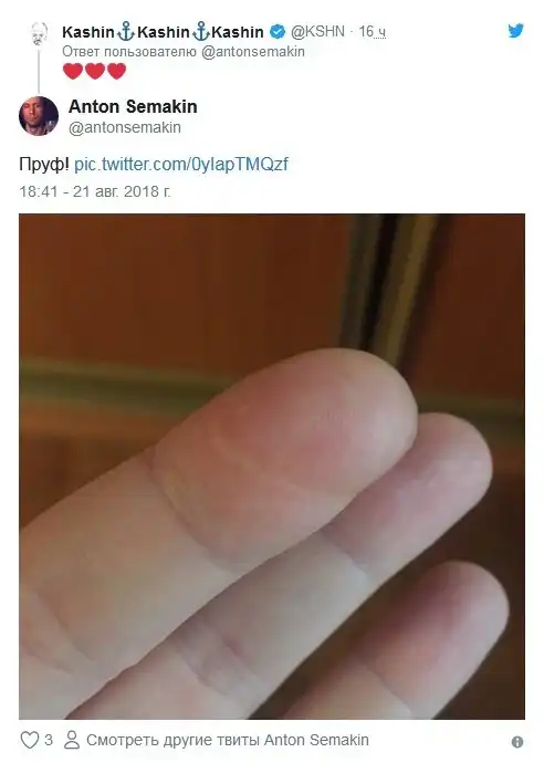 "Необъяснимые" шрамы на указательном пальце левой руки