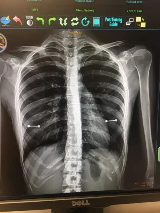 Девушка сделала пирсинг без ведома родителей, но очень глупо "спалилась"