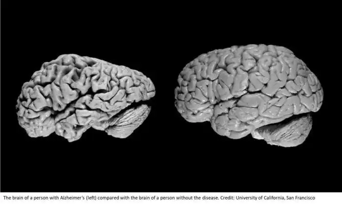Безумная старость: болезнь Альцгеймера.