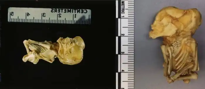 Каменные люди: фибродисплазия - история болезни.