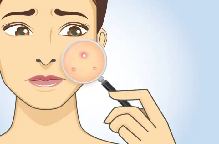 Вредно ли давить прыщи?
