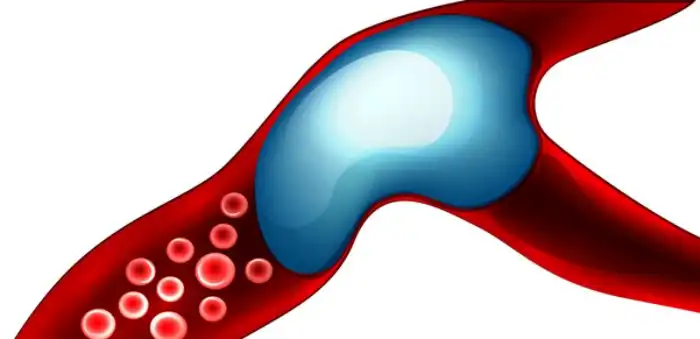 Что если воздух из иголки попадет в вену