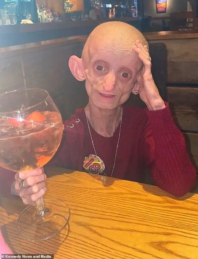 Девочка с "синдромом Бенджамина Баттона" умерла в теле старухи