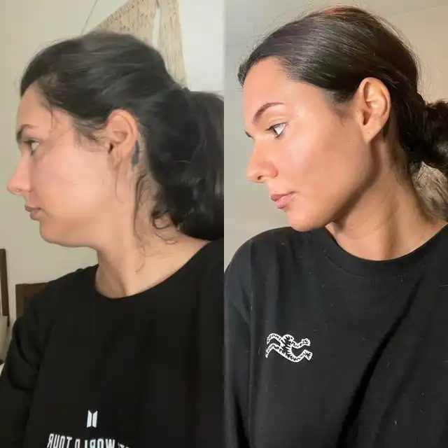 Люди, которые наконец решились на пластическую операцию - и ни на секунду не пожалели