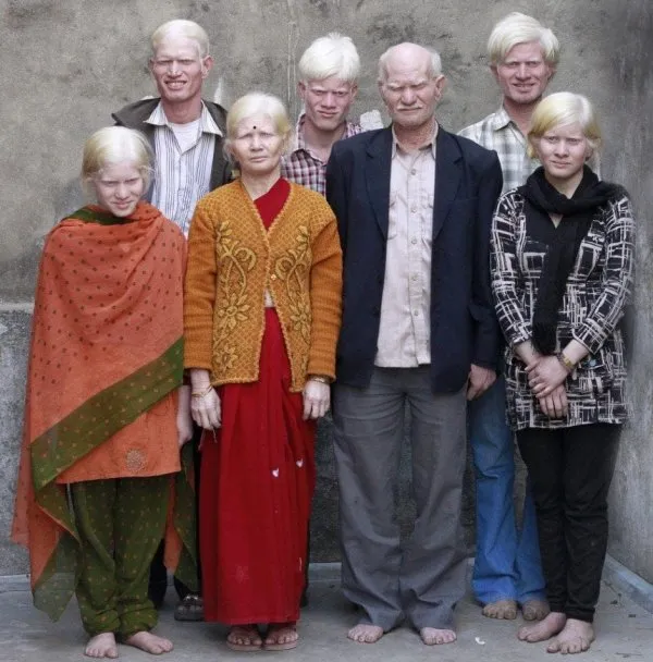 "Белые вороны": удивительные люди-альбиносы разных национальностей