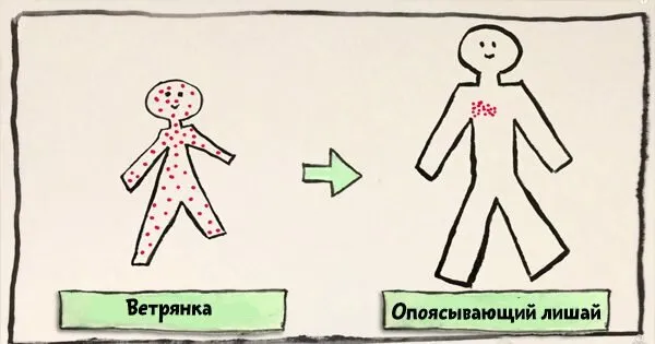 «Хитрый» вирус: как ветрянка превращается в опоясывающий лишай