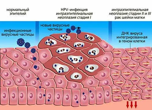 Как работают папилломавирусы человека и возможно ли их победить ?
