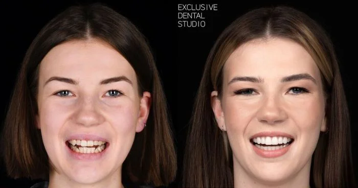Улыбка до и после: 15 фотографий, подтверждающих магию стоматологии