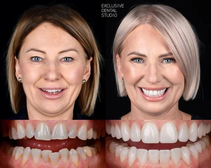 Улыбка до и после: 15 фотографий, подтверждающих магию стоматологии