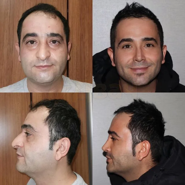 Мастера из Турции: удивительные преображения благодаря пластической хирургии