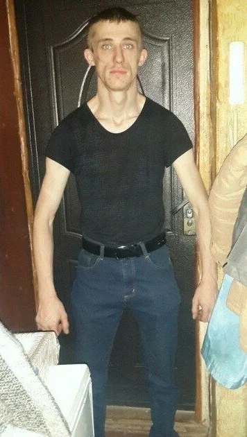 Синдром широкой спины